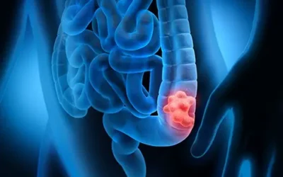 Early Symptoms of Colorectal Cancer