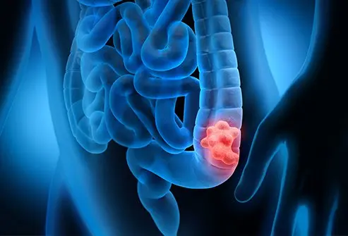 Early Symptoms of Colorectal Cancer
