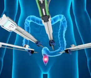 Robotic Surgery for Colon Cancer