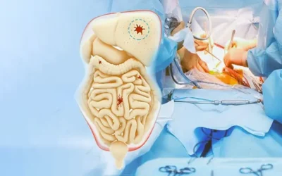 What Is HIPEC Surgery and Who Needs It?