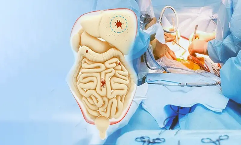 What Is HIPEC Surgery and Who Needs It?