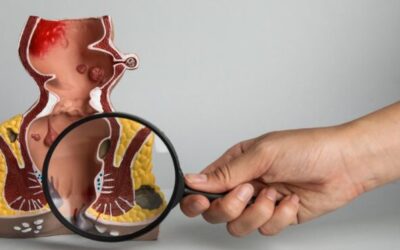 What Is Sphincter Saving Surgery?