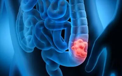 Early Signs of Colon Cancer