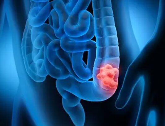 Early Signs of Colon Cancer