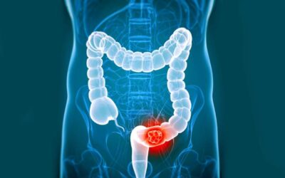 How Is Colorectal Cancer Diagnosed Early?