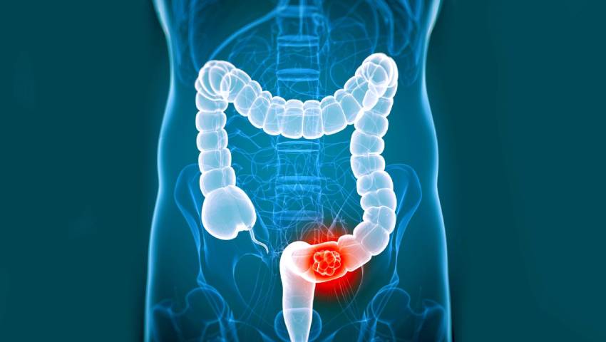 How is colorectal cancer diagnosed early? Dr. Sandeep Nayak