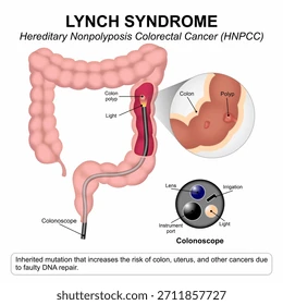 Infographic on Lynch syndrome (HNPCC) showing a colon with a highlighted polyp and inset diagrams of colonoscopy and genetic risk in hereditary colorectal cancer.