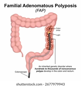 Diagram of familial adenomatous polyposis showing numerous colon polyps and inherited genetic risk in the colon tract.