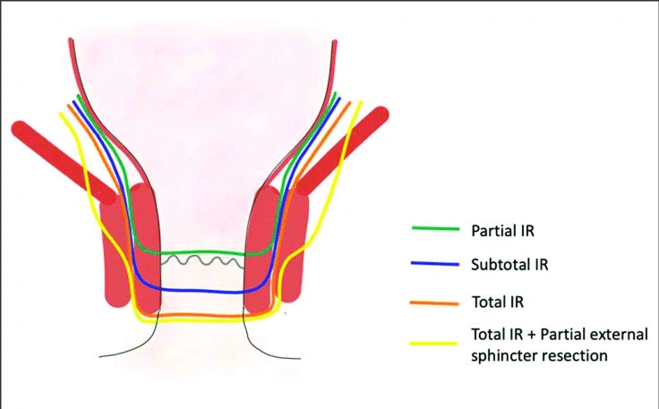 Cross-sectional schematic of the anal canal showing sphincters with color-coded lines: green = partial internal sphincter, blue = subtotal internal, orange = total internal, yellow = total internal plus partial external sphincter resection.