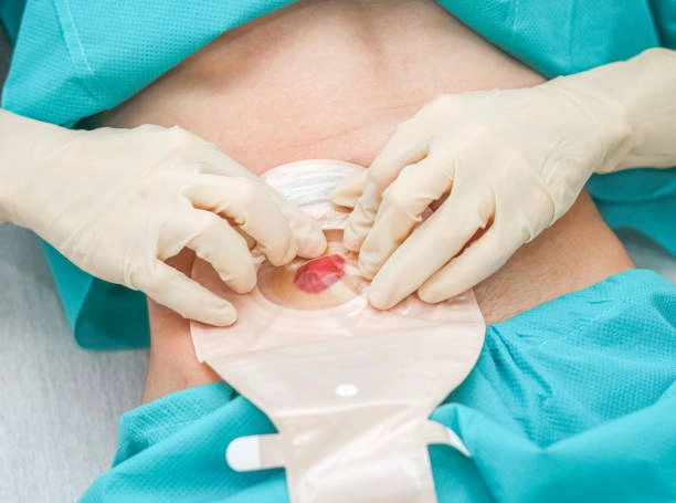 Close-up of gloved hands applying a circular ostomy pouch to an abdominal stoma in a surgical setting.
