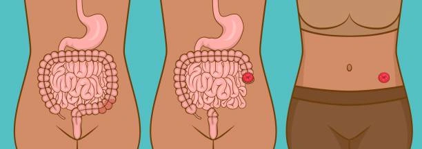 Three-panel diagram of the abdomen showing the digestive tract (stomach and intestines) with a healthy gut, viewed from the front.