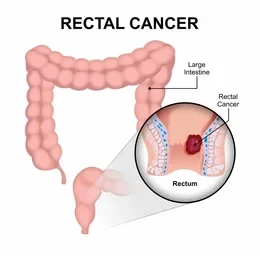 Diagram of the large intestine showing rectal cancer in the rectum with a magnified inset of the tumor.