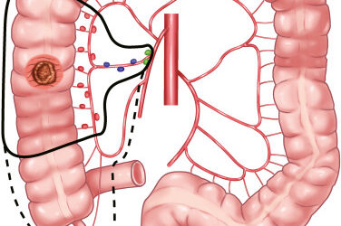 D3 vs D2 Lymph Node Dissection: What Is the Difference?