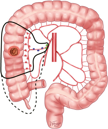 Surgeon reviewing colon cancer lymph node dissection diagram showing D2 and D3 nodal stations