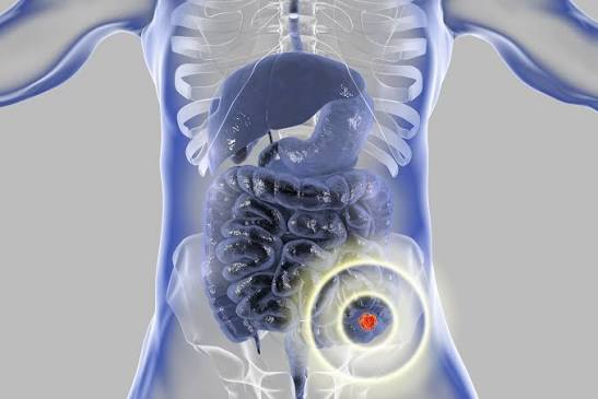 Doctor reviewing rectal cancer scan results with patient during a wait and watch follow-up consultation