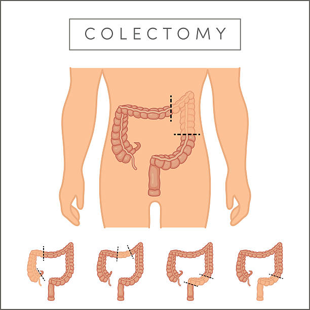 image1 Medical illustration of a human abdomen showing the colon and dotted lines indicating an operative removal (colectomy) with four option diagrams below.