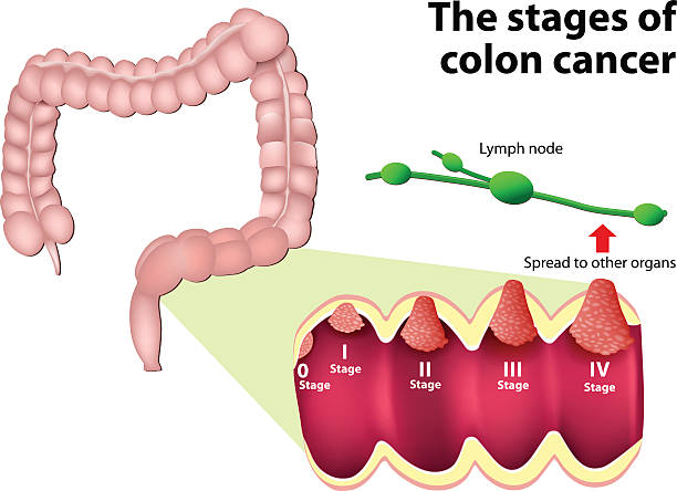 Diagram of the large intestine showing colon cancer stages I–IV with a cross‑section of the intestinal wall and a nearby lymph node illustrating possible spread to other organs.
