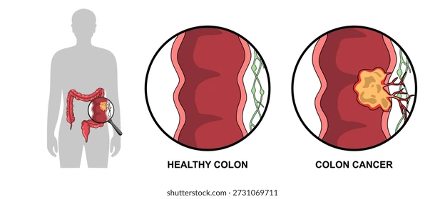 image10 Infographic comparing a healthy colon and colon cancer, with a magnifier highlighting a polyp in the colon on the left.”