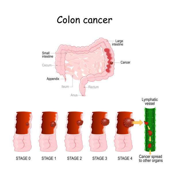 Educational diagram of the large intestine showing colon cancer and tumor progression from Stage 0 to Stage 4, with lymphatic spread to other organs.