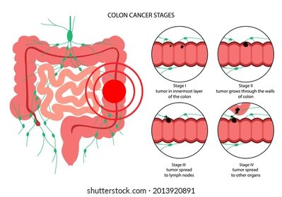 image4 Diagram of the colon showing a large red tumor with five circular panels labeled Stage I–Stage V, illustrating cancer invasion and spread.