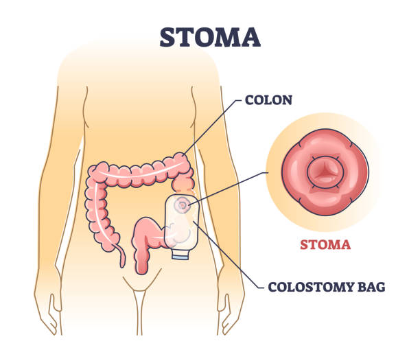An anatomical diagram showing a colon with a stoma on the abdomen connected to a colostomy bag; inset highlights the stoma.