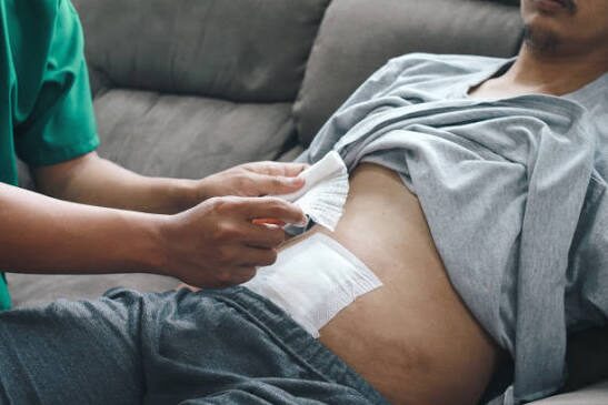 Healthcare worker applies a gauze dressing to a man's abdomen while he rests on a couch, showing a bandage being placed over the wound non-verbally healing context.