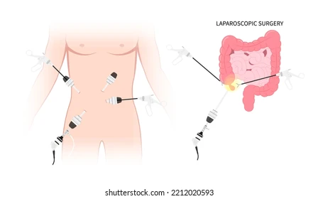 image6 Illustration of laparoscopic abdominal surgery with multiple trocars and instruments; inset shows the colon with a highlighted target area.