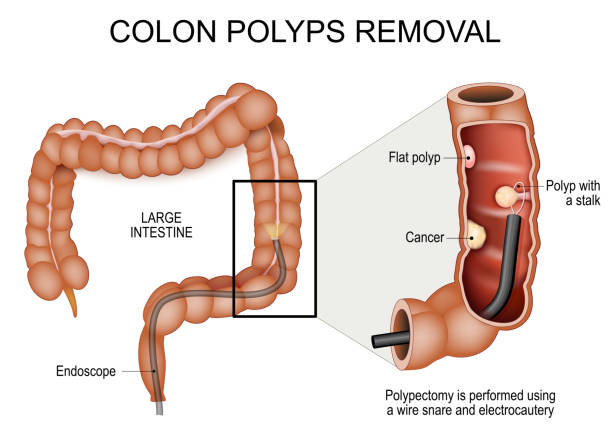 Illustration of colon polyp removal: endoscope in the large intestine, a stalked polyp being snared and removed with electrocautery.