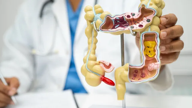 Colonoscopy Guide When You Need One