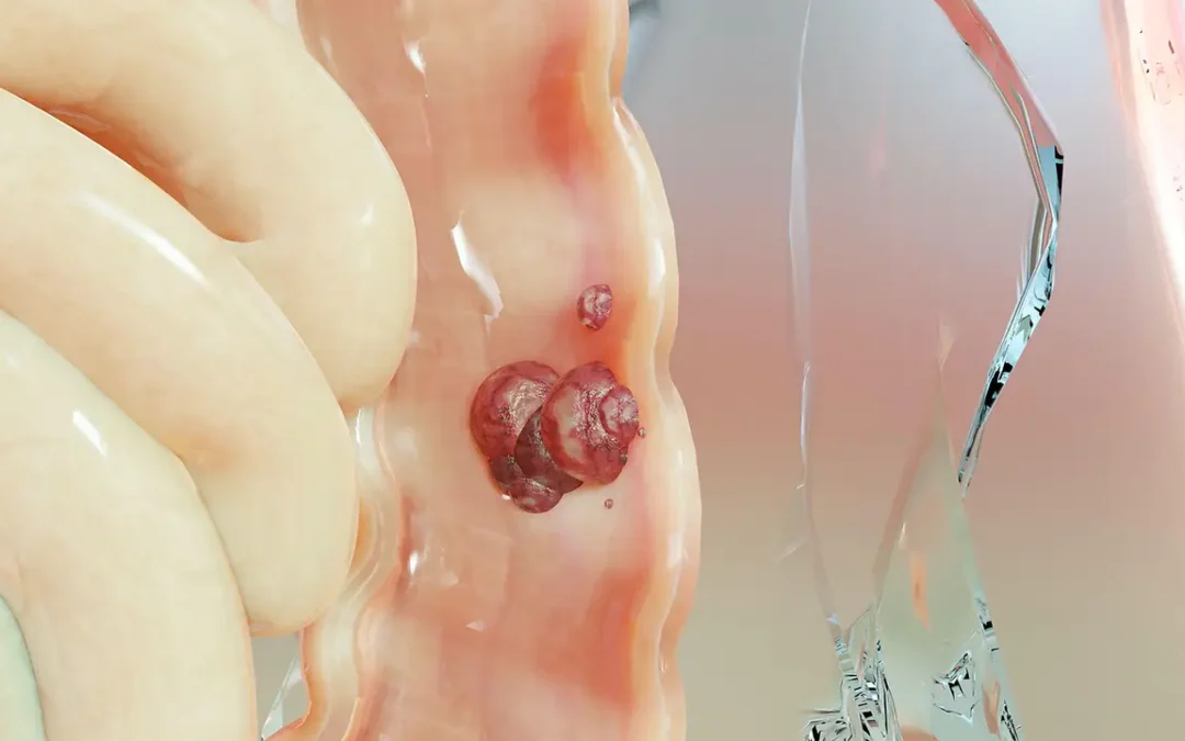 Blood in Stool Is It Always Colorectal Cancer